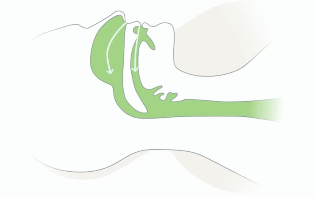 Diagram of head and neck in profile showing clear green airflow through nose and mouth with a dental mouthpiece holding the jaw forward
